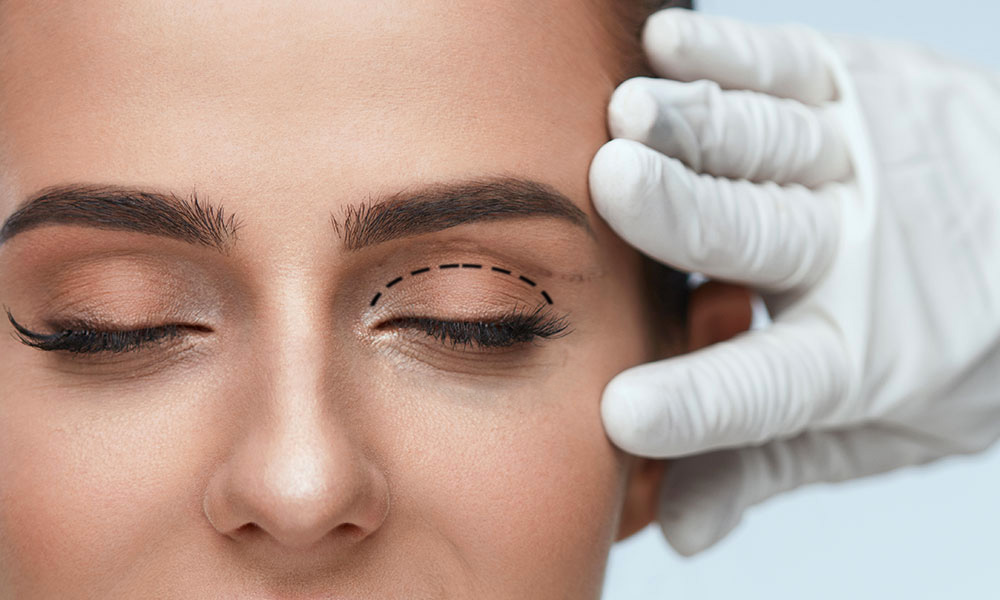 blepharoplastie superieure